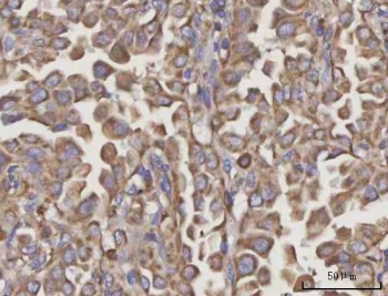 IHC staining of FFPE human lung cancer tissue with NDUFA4 antibody. HIER: boil tissue sections in pH8 EDTA for 20 min and allow to cool before testing.