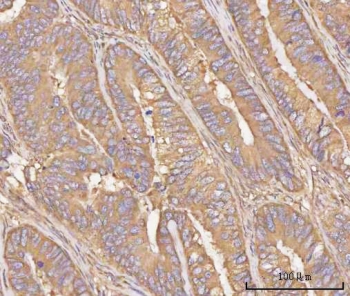 IHC staining of FFPE human rectum adenocarcinoma tissue with PPP3CB antibody. HIER: boil tissue sections in pH8 EDTA for 20 min and allow to cool before testing.