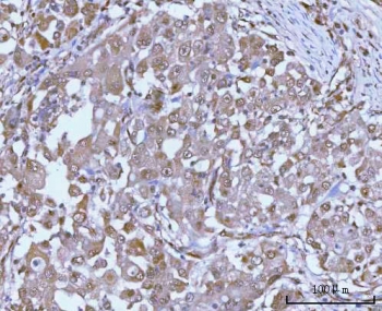 IHC staining of FFPE human lung adenocarcinoma tissue with PSMC4 antibody. HIER: boil tissue sections in pH8 EDTA for 20 min and allow to cool before testing.