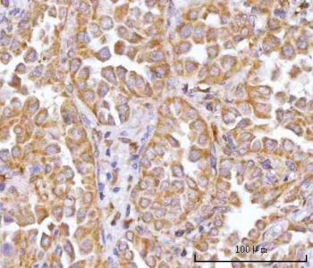 IHC staining of FFPE human lung cancer tissue with TRNT1 antibody. HIER: boil tissue sections in pH8 EDTA for 20 min and allow to cool before testing.