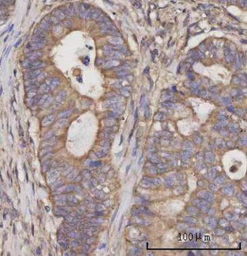 IHC staining of FFPE human rectum adenocarcinoma tissue with Selenocysteine lyase antibody. HIER: boil tissue sections in pH8 EDTA for 20 min and allow to cool before testing.