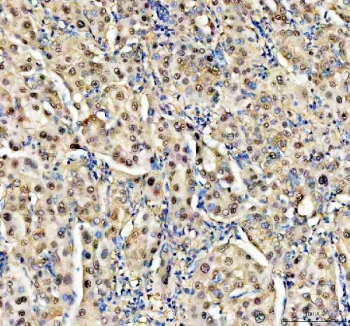 IHC staining of FFPE human liver cancer tissue with NUDT5 antibody. HIER: boil tissue sections in pH8 EDTA for 20 min and allow to cool before testing.