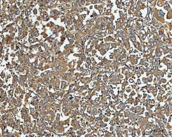 IHC staining of FFPE human lung cancer tissue with NT5C antibody. HIER: boil tissue sections in pH8 EDTA for 20 min and allow to cool before testing.