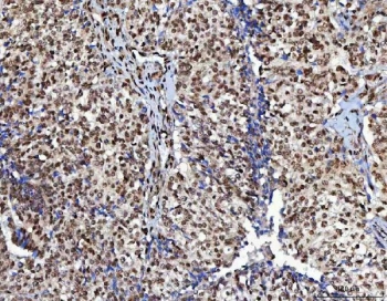 IHC staining of FFPE human ovarian cancer tissue with CML66 antibody. HIER: boil tissue sections in pH8 EDTA for 20 min and allow to cool before testing.