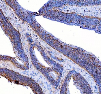 IHC staining of FFPE human colon cancer tissue with RSPH3 antibody. HIER: boil tissue sections in pH8 EDTA for 20 min and allow to cool before testing.
