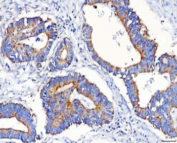 IHC staining of FFPE human colorectal adenocarcinoma tissue with METAP1D antibody. HIER: boil tissue sections in pH8 EDTA for 20 min and allow to cool before testing.