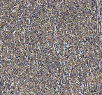 IHC staining of FFPE human large B-cell lymphoma tissue with NEEP21 antibody. HIER: boil tissue sections in pH8 EDTA for 20 min and allow to cool before testing.