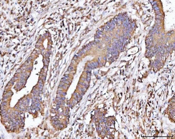 IHC staining of FFPE human colorectal adenocarcinoma tissue with MICAL-like protein 2 antibody. HIER: boil tissue sections in pH8 EDTA for 20 min and allow to cool before testing.