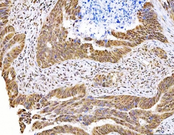 IHC staining of FFPE human bladder urothelial carcinoma tissue with MAGED4 antibody. HIER: boil tissue sections in pH8 EDTA for 20 min and allow to cool before testing.
