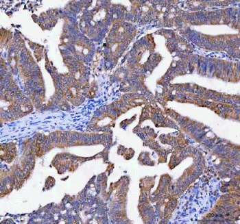 IHC staining of FFPE human rectum adenocarcinoma tissue with Lysophospholipase 1 antibody. HIER: boil tissue sections in pH8 EDTA for 20 min and allow to cool before testing.