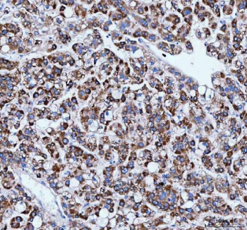 IHC staining of FFPE human liver cancer tissue with IARS1 antibody. HIER: boil tissue sections in pH8 EDTA for 20 min and allow to cool before testing.