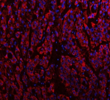 Immunofluorescent staining of FFPE human liver cancer tissue with IDH3A antibody (red) and DAPI nuclear stain (blue). HIER: steam section in pH8 EDTA buffer for 20 min.
