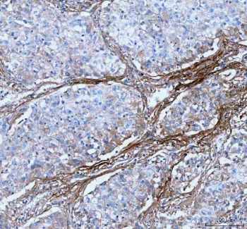 IHC staining of FFPE human lung cancer tissue with Lumican antibody. HIER: boil tissue sections in pH8 EDTA for 20 min and allow to cool before testing.