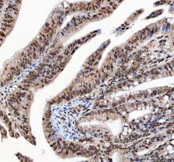 IHC staining of FFPE human rectum adenocarcinoma tissue with ILF2 antibody. HIER: boil tissue sections in pH8 EDTA for 20 min and allow to cool before testing.