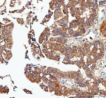 IHC staining of FFPE human rectum adenocarcinoma tissue with IDI1 antibody. HIER: boil tissue sections in pH8 EDTA for 20 min and allow to cool before testing.