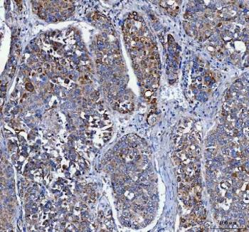 IHC staining of FFPE human liver cancer tissue with LRRC75B antibody. HIER: boil tissue sections in pH8 EDTA for 20 min and allow to cool before testing.