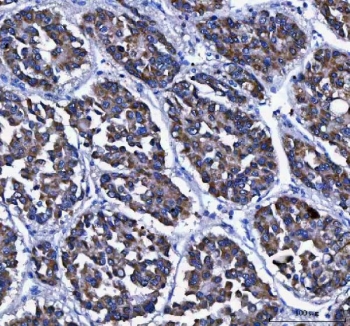 IHC staining of FFPE human liver cancer tissue with LGI4 antibody. HIER: boil tissue sections in pH8 EDTA for 20 min and allow to cool before testing.