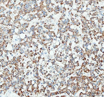 IHC staining of FFPE human liver cancer tissue with RAB3IP antibody. HIER: boil tissue sections in pH8 EDTA for 20 min and allow to cool before testing.