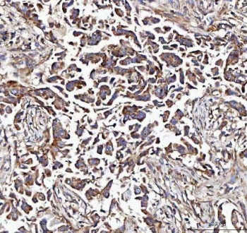 IHC staining of FFPE human breast cancer tissue with MCCC2 antibody. HIER: boil tissue sections in pH8 EDTA for 20 min and allow to cool before testing.
