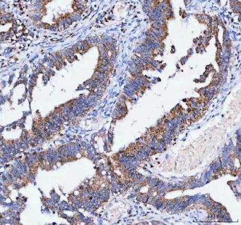 IHC staining of FFPE human rectum adenocarcinoma tissue with IARS2 antibody. HIER: boil tissue sections in pH8 EDTA for 20 min and allow to cool before testing.