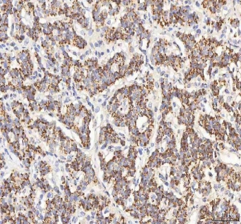 IHC staining of FFPE human lung cancer tissue with BPNT2 antibody. HIER: boil tissue sections in pH8 EDTA for 20 min and allow to cool before testing.