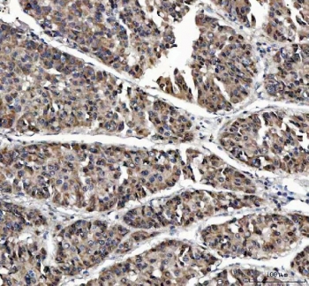 IHC staining of FFPE human liver cancer tissue with MAGEL2 antibody. HIER: boil tissue sections in pH8 EDTA for 20 min and allow to cool before testing.