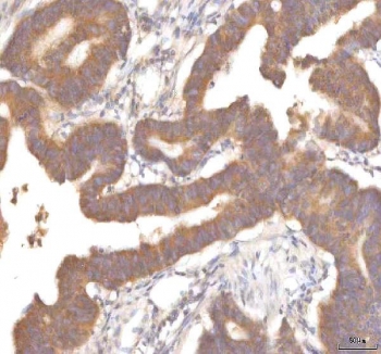 IHC staining of FFPE human colon adenocarcinoma tissue with MFSD12 antibody. HIER: boil tissue sections in pH8 EDTA for 20 min and allow to cool before testing.