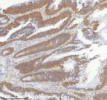 IHC staining of FFPE human colon adenocarcinoma tissue with METTL18 antibody. HIER: boil tissue sections in pH8 EDTA for 20 min and allow to cool before testing.