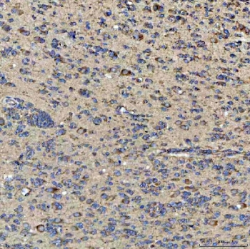 IHC staining of FFPE human glioblastoma tissue with GlnRS antibody. HIER: boil tissue sections in pH8 EDTA for 20 min and allow to cool before testing.