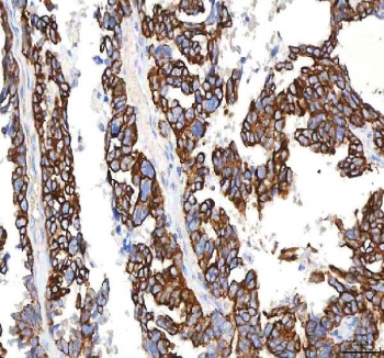 IHC staining of FFPE human mucinous adenoma of the ovary tissue with PKDCC antibody. HIER: boil tissue sections in pH8 EDTA for 20 min and allow to cool before testing.