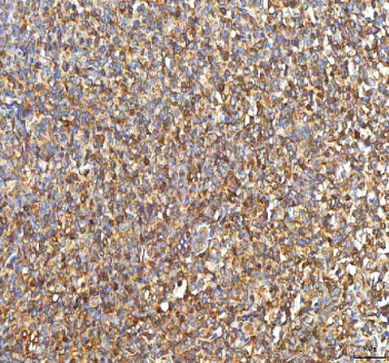 IHC staining of FFPE human diffuse large B cell lymphoma tissue with PFKP antibody. HIER: boil tissue sections in pH8 EDTA for 20 min and allow to cool before testing.