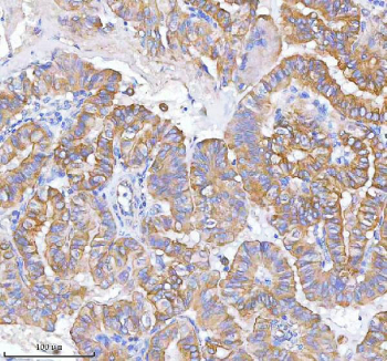 IHC staining of FFPE human thyroid papillary carcinoma tissue with MLKL antibody. HIER: boil tissue sections in pH8 EDTA for 20 min and allow to cool before testing.