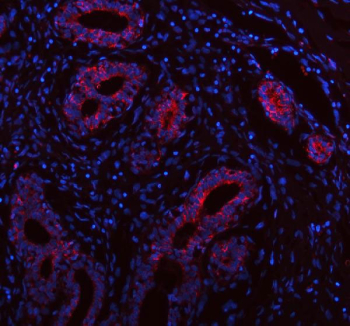 Immunofluorescent staining of FFPE human breast cancer tissue with INTU antibody (red) and DAPI nuclear stain (blue). HIER: steam section in pH8 EDTA buffer for 20 min.
