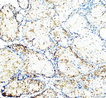 IHC staining of FFPE human teratoma tissue with CD24 antibody, HRP-labeled secondary and DAB substrate. HIER: boil tissue sections in pH8 EDTA for 20 min and allow to cool before testing.