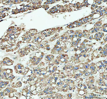 IHC staining of FFPE human liver cancer tissue with ARHGEF12 antibody, HRP-labeled secondary and DAB substrate. HIER: boil tissue sections in pH8 EDTA for 20 min and allow to cool before testing.