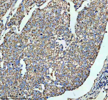 IHC staining of FFPE human cervical cancer tissue with SLC16A1 antibody, HRP-secondary and DAB substrate. HIER: boil tissue sections in pH8 EDTA for 20 min and allow to cool before testing.
