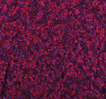 Immunofluorescent staining of FFPE human gastric cancer tissue with ME1 antibody (red) and DAPI nuclear stain (blue). HIER: steam section in pH8 EDTA buffer for 20 min.