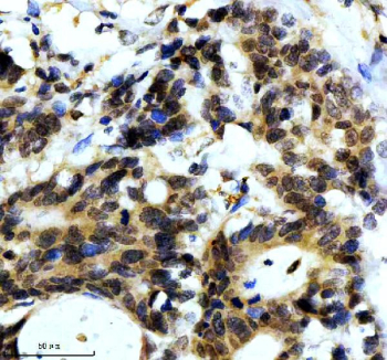 IHC staining of FFPE human colon cancer tissue with Alpha-Synuclein antibody, HRP-secondary and DAB substrate. HIER: boil tissue sections in pH8 EDTA for 20 min and allow to cool before testing.