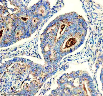 IHC staining of FFPE human colon cancer tissue with CHMP2B antibody, HRP-secondary and DAB substrate. HIER: boil tissue sections in pH8 EDTA for 20 min and allow to cool before testing.