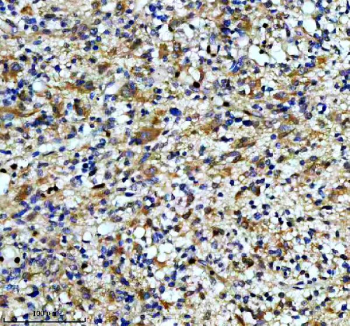 IHC staining of FFPE human glioma tissue with CAMK2 antibody, HRP-secondary and DAB substrate. HIER: boil tissue sections in pH8 EDTA for 20 min and allow to cool before testing.