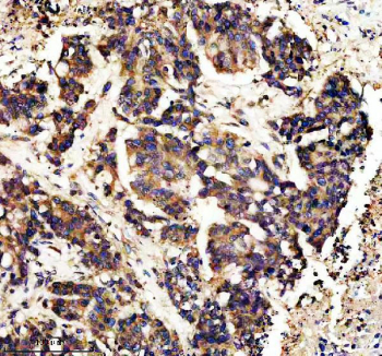 IHC staining of FFPE human colon cancer tissue with CAMK II alpha antibody, HRP-secondary and DAB substrate. HIER: boil tissue sections in pH8 EDTA for 20 min and allow to cool before testing.