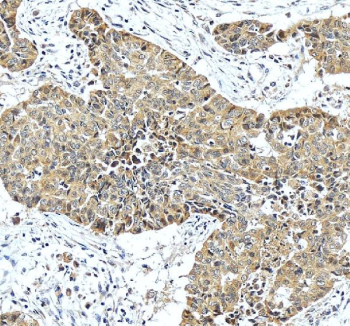 IHC staining of FFPE human liver cancer tissue with HPD antibody, HRP-secondary and DAB substrate. HIER: boil tissue sections in pH8 EDTA for 20 min and allow to cool before testing.
