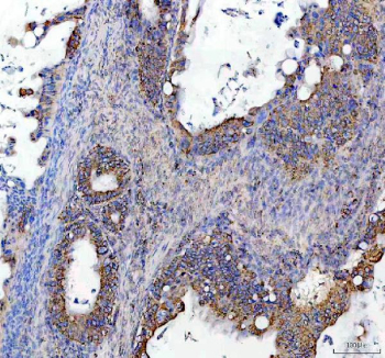 IHC staining of FFPE human ovarian tissue with SOCS5 antibody, HRP-secondary and DAB substrate. HIER: boil tissue sections in pH8 EDTA for 20 min and allow to cool before testing.