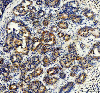 IHC staining of FFPE human breast cancer tissue with STXBP4 antibody, HRP-secondary and DAB substrate. HIER: boil tissue sections in pH8 EDTA for 20 min and allow to cool before testing.