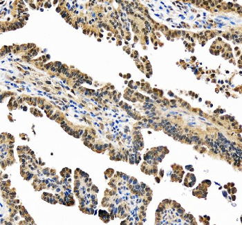 IHC staining of FFPE human ovarian cancer tissue with PSMC1 antibody, HRP-secondary and DAB substrate. HIER: boil tissue sections in pH8 EDTA for 20 min and allow to cool before testing.