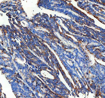 IHC staining of FFPE human colon cancer tissue with CPT2 antibody, HRP-secondary and DAB substrate. HIER: boil tissue sections in pH8 EDTA for 20 min and allow to cool before testing.