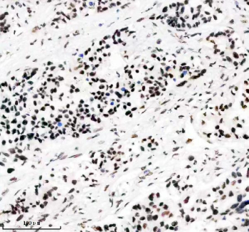 IHC staining of FFPE human lung cancer tissue with PABPN1 antibody, HRP-secondary and DAB substrate. HIER: boil tissue sections in pH8 EDTA for 20 min and allow to cool before testing.