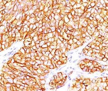 IHC testing of formalin-paraffin human renal cell carcinoma stained with CAIX antibody (66.4.C2). Note cytoplasmic & cell surface staining of tumor cells.