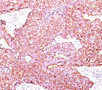 IHC testing of human small cell lung carcinoma stained with Chromogranin A antibody (clone PHE5).