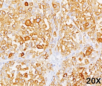 MART-1 / Melan-A antibody M2-9E3 immunohistochemistry 1